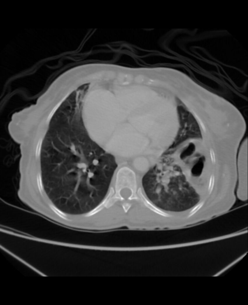 Chondrosarcoma (Radiopaedia 79427-92535 Axial lung window 35).jpg