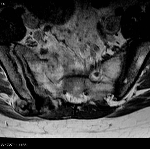 File:Chondrosarcoma - sacrum (Radiopaedia 6173-7627 Axial T1 C+ 1).jpg