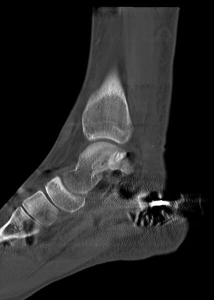 File:Chopart fracture (Radiopaedia 35347-36861 Sagittal bone window 35).jpg