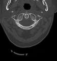 Chordoma (C4 vertebra) (Radiopaedia 47561-52188 Axial bone window 9).png