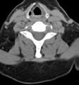 Chordoma (C4 vertebra) (Radiopaedia 47561-52188 Axial non-contrast 34).png