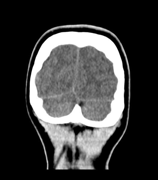 File:Choroid plexus carcinoma (Radiopaedia 91013-108552 Coronal non-contrast 78).jpg