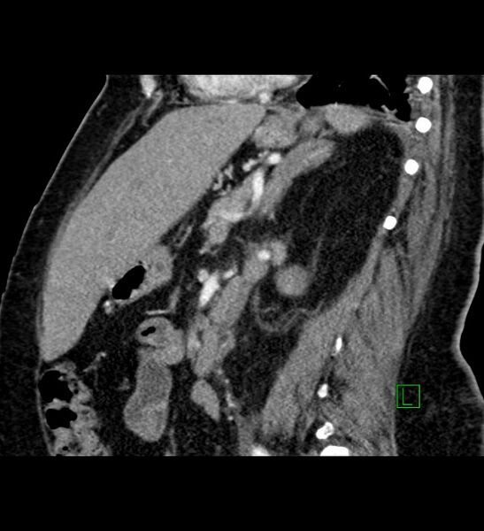 File:Chromophobe renal cell carcinoma (Radiopaedia 84239-99519 D 52).jpg