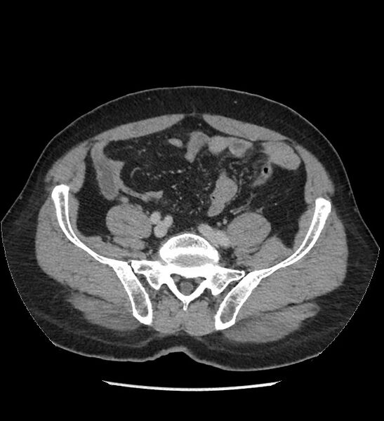 File:Chromophobe renal cell carcinoma (Radiopaedia 86879-103083 C 110).jpg