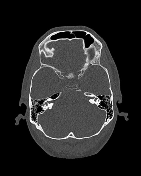 File:Chronic maxillary sinusitis caused by a foreign body (Radiopaedia 58521-65676 Axial bone window 259).jpg