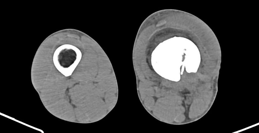 Chronic osteomyelitis (with sequestrum) (Radiopaedia 74813-85822 D 144).jpg