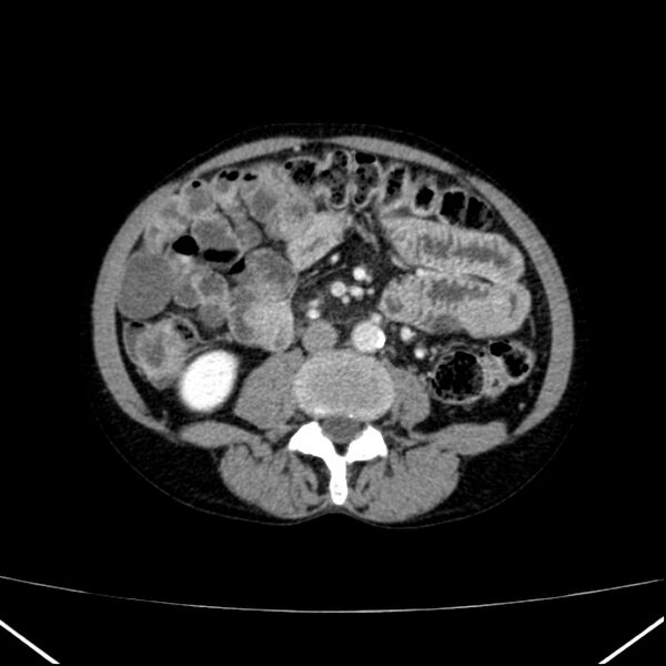File:Chronic pancreatitis (Radiopaedia 23132-23172 B 35).jpg