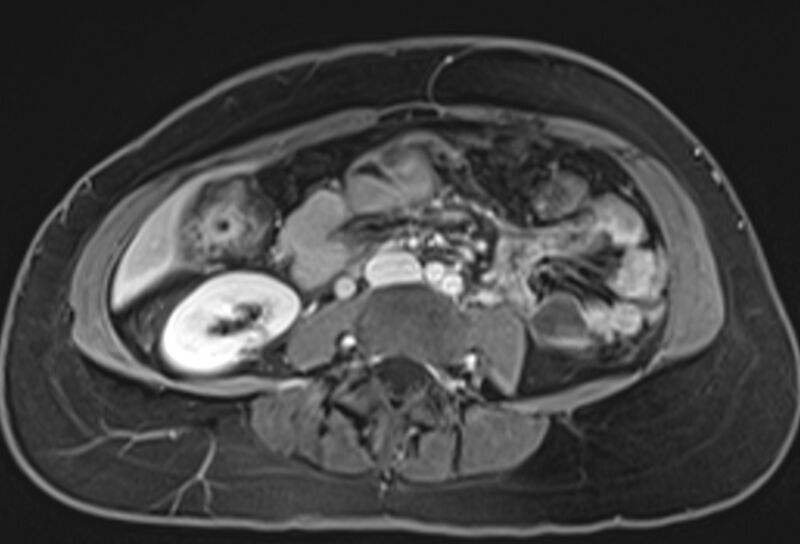 File:Chronic pancreatitis - pancreatic duct calculi (Radiopaedia 71818-82250 Axial T1 C+ fat sat 48).jpg
