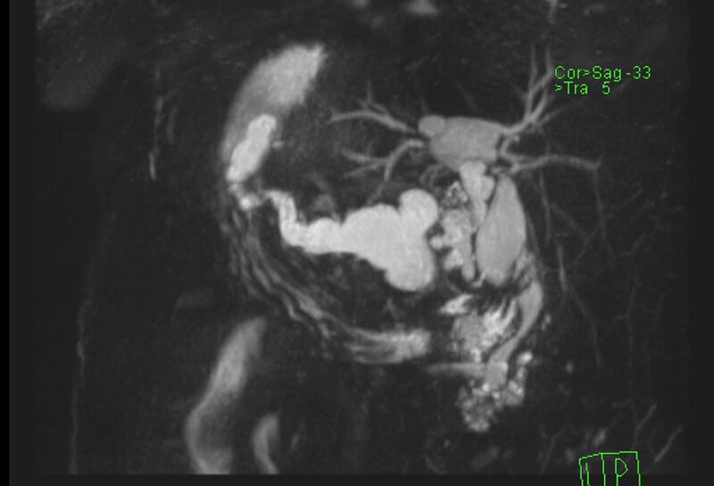 File:Chronic pancreatitis - pancreatic duct calculi (Radiopaedia 71818-82250 MRCP T2 12).jpg