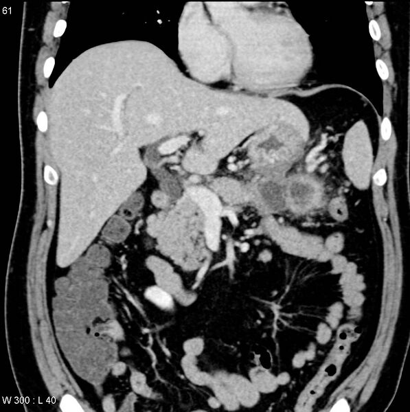File:Chronic pancreatitis and pseudocysts (Radiopaedia 6724-7935 E 5).jpg