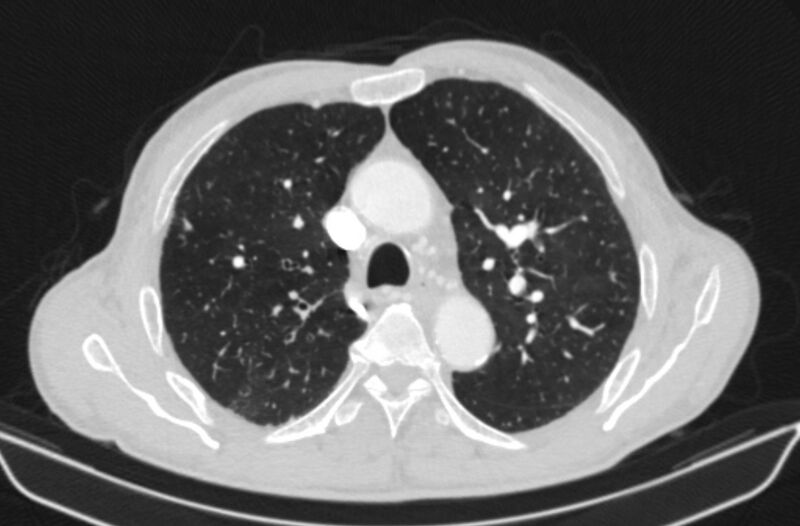 File:Chronic pulmonary embolism (Radiopaedia 91241-108843 Axial lung window 29).jpg