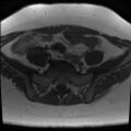 Class II Mullerian duct anomaly- unicornuate uterus with rudimentary horn and non-communicating cavity (Radiopaedia 39441-41755 Axial T1 4).jpg