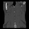 Clay-shoveler fracture (Radiopaedia 22568-22590 Coronal bone window 1).jpg