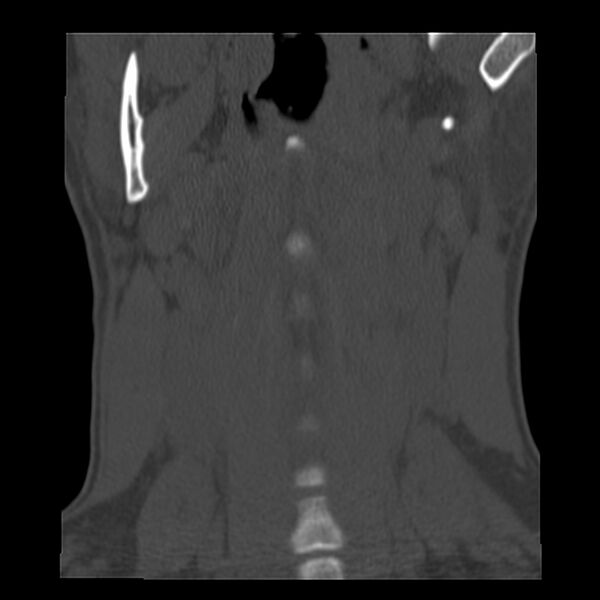 File:Clay-shoveler fracture (Radiopaedia 22568-22590 Coronal bone window 1).jpg