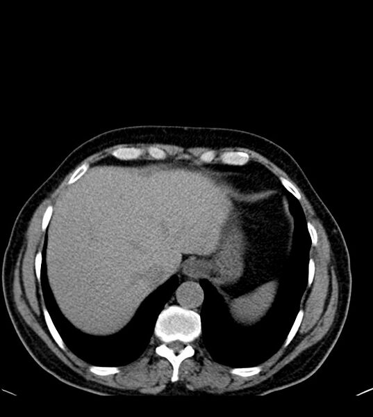 File:Clear cell renal cell carcinoma (Radiopaedia 85006-100539 Axial non-contrast 17).jpg