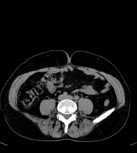 File:Clear cell renal cell carcinoma (Radiopaedia 85006-100539 Axial non-contrast 56).jpg
