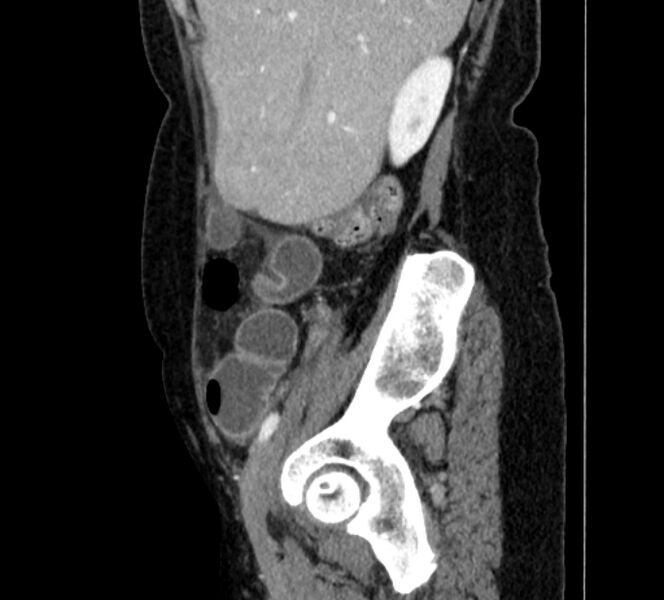 File:Closed loop small bowel obstruction (Radiopaedia 71211-81508 C 20).jpg