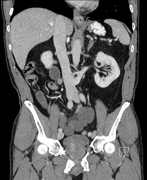 File:Closed loop small bowel obstruction - internal hernia (Radiopaedia 57806-64778 A 59).jpg