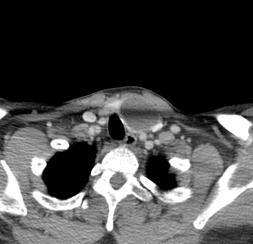 Colloid cyst of thyroid (Radiopaedia 22897-22923 Axial C+ delayed 67).jpg