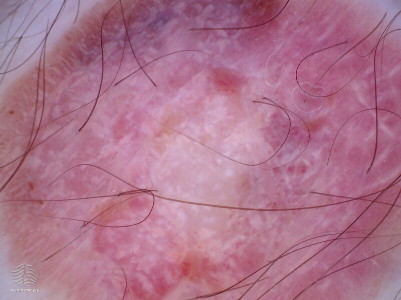 File:Dermoscopic image of amelanotic melanoma 5 (DermNet NZ amelanotic-melanoma4-dermoscopic2).jpg