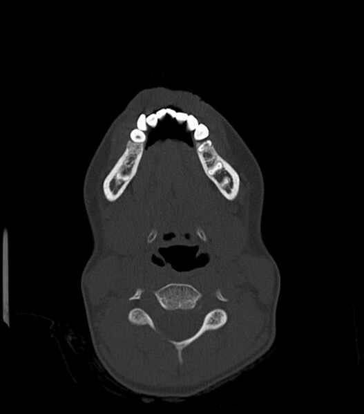File:Nasoorbitoethmoid fracture (Radiopaedia 90044-107205 Axial bone window 27).jpg