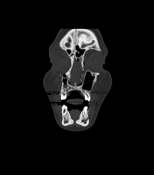 File:Nasoorbitoethmoid fracture (Radiopaedia 90044-107205 Coronal bone window 32).jpg