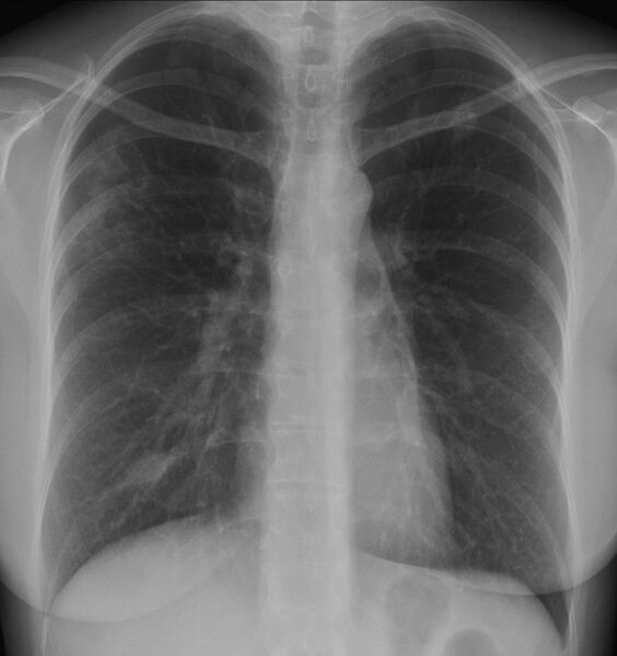 File:Necrobiotic pulmonary nodules - Crohn disease (Radiopaedia 20723-20632 Frontal 1).jpg
