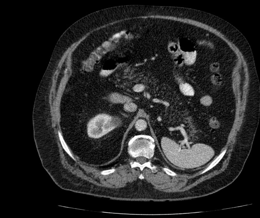 Nephroptosis with inguinal hernia containing perirenal fat (Radiopaedia 56632-63391 C 110).jpg