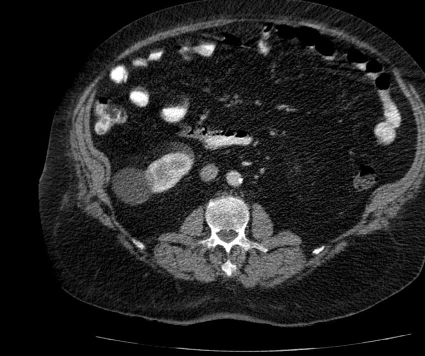Nephroptosis with inguinal hernia containing perirenal fat (Radiopaedia 56632-63391 C 167).jpg