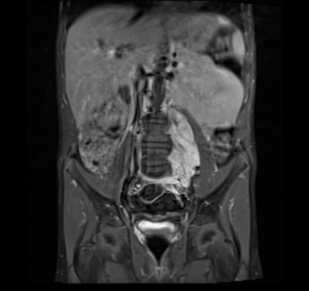 File:Neuroblastoma (Radiopaedia 6010-7518 Coronal T1 fat sat 5).jpg