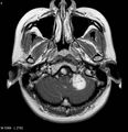 Neurofibromatosis type 2 - cranial and spinal involvement (Radiopaedia 5351-7111 Axial T1 C+ 1).jpg