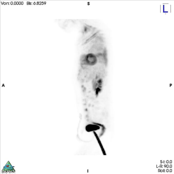 File:Non-Hodgkin lymphoma involving seminal vesicles with development of interstitial pneumonitis during Rituximab therapy (Radiopaedia 32703-33761 PET cor 3D MIP 4).jpg
