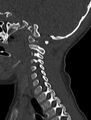 Normal CT cervical spine - pediatric (Radiopaedia 52549-58462 Sagittal bone window 58).jpg