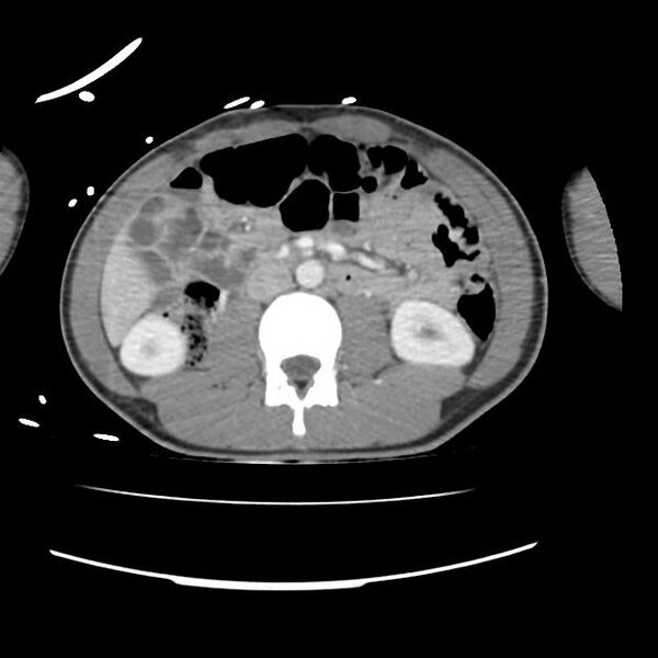 File:Normal dual-phase trauma CT chest,abdomen and pelvis (Radiopaedia 48092-52899 A 71).jpg