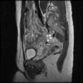 Normal female pelvis MRI (retroverted uterus) (Radiopaedia 61832-69933 Sagittal T2 11).jpg