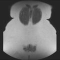 Normal liver MRI with Gadolinium (Radiopaedia 58913-66163 Coronal T2 40).jpg