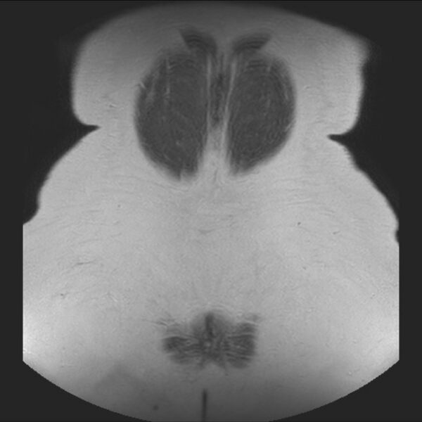 File:Normal liver MRI with Gadolinium (Radiopaedia 58913-66163 Coronal T2 40).jpg