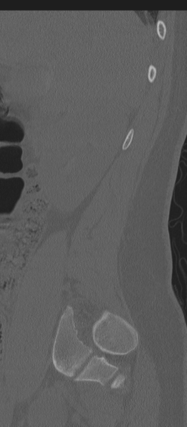 File:Normal lumbosacral CT (Radiopaedia 37923-39867 Sagittal bone window 85).png