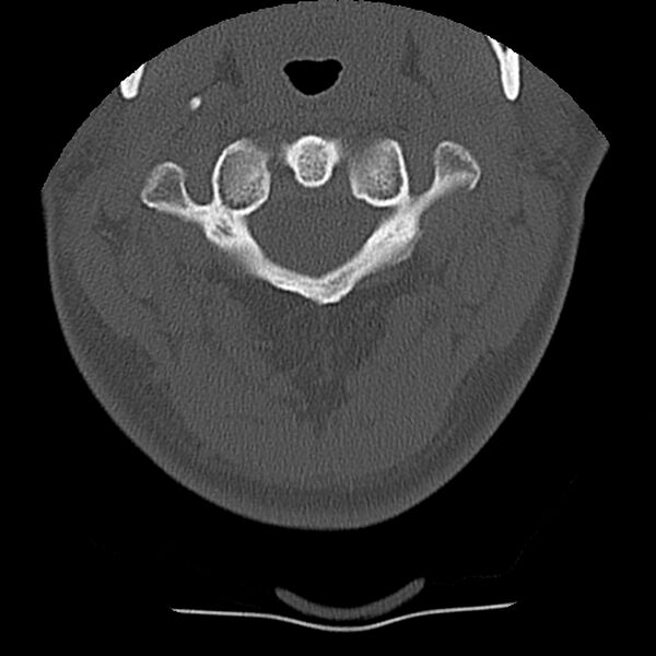 File:Normal trauma spine imaging (Radiopaedia 31753-32686 Axial bone window 12).jpg