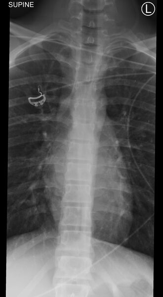 File:Normal trauma spine imaging (age 16) (Radiopaedia 45335-49357 Frontal 1).jpg