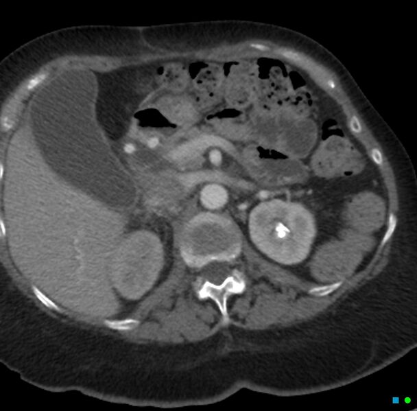 File:Obstructed infected horseshoe kidney (Radiopaedia 18116-17898 B 3).jpg