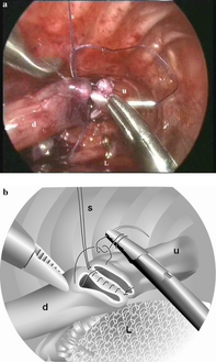 a) Thoracoscopic repair of esophageal atresia, b) picture demonstrating the start of the anterior running suture