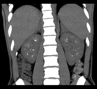 Non-contrast coronal CT depicts nephrocalcinosis.