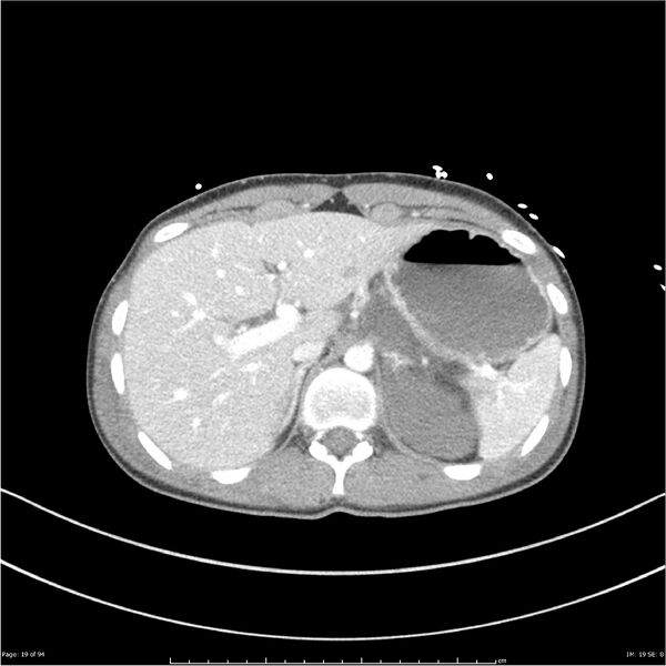 File:Traumatic renal artery dissection and pancreatic transection (Radiopaedia 37061-38739 Axial 265).jpg