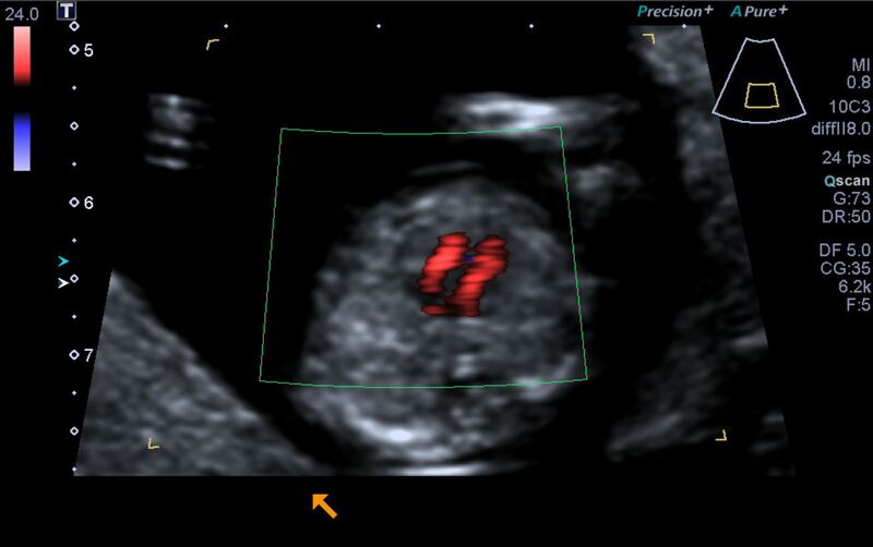 File:1st trimester nuchal-morphology ultrasound (Radiopaedia 44706-48477 Heart views cine with colour 113).jpg