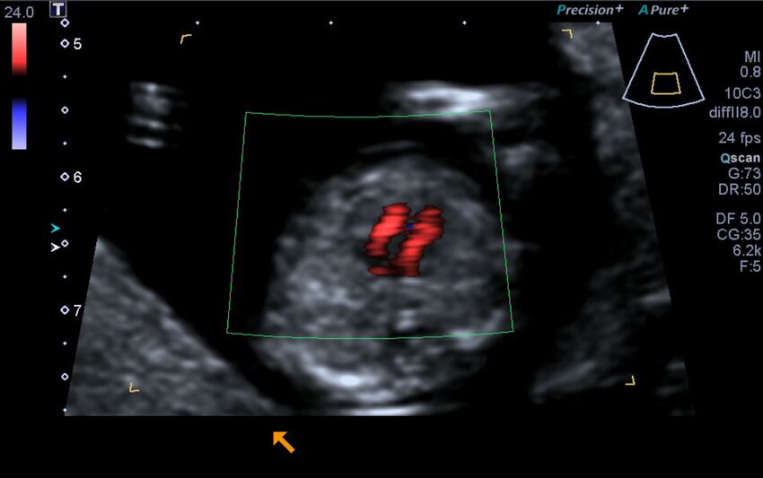 1st trimester nuchal-morphology ultrasound (Radiopaedia 44706-48477 Heart views cine with colour 113).jpg