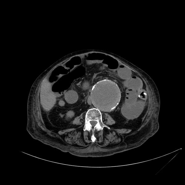 File:Abdominal aortic aneurysm - impending rupture (Radiopaedia 19233-19246 Axial non-contrast 71).jpg