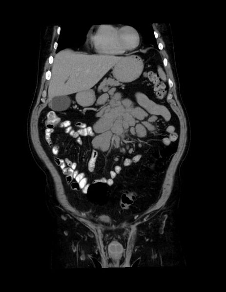 File:Abdominal lymphoma - with sandwich sign (Radiopaedia 53486-59492 C+ portal venous phase 42).jpg