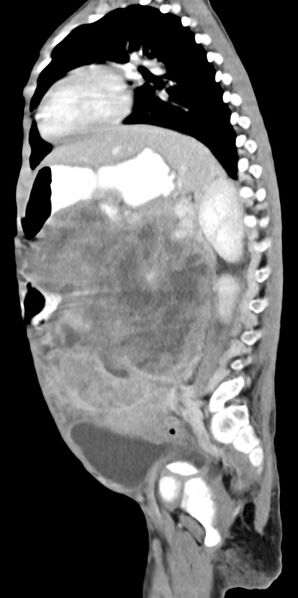 File:Abdominopelvic rhabdomyosarcoma (Radiopaedia 78356-90984 Sagittal C+ portal venous phase 35).jpg