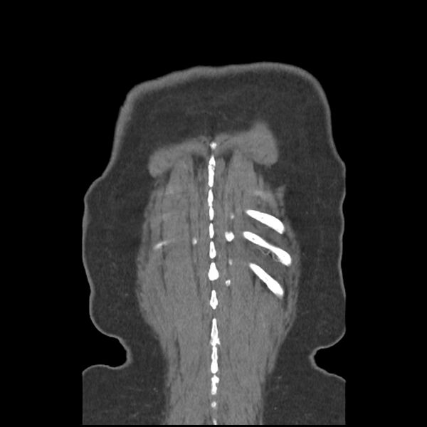 File:Aberrant right subclavian and left vertebral arteries (Radiopaedia 43467-46847 Coronal C+ portal venous phase 83).jpg